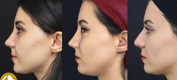 عکس برداری قبل جراحی بینی