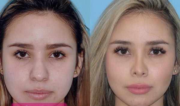 عکس برداری قبل جراحی بینی