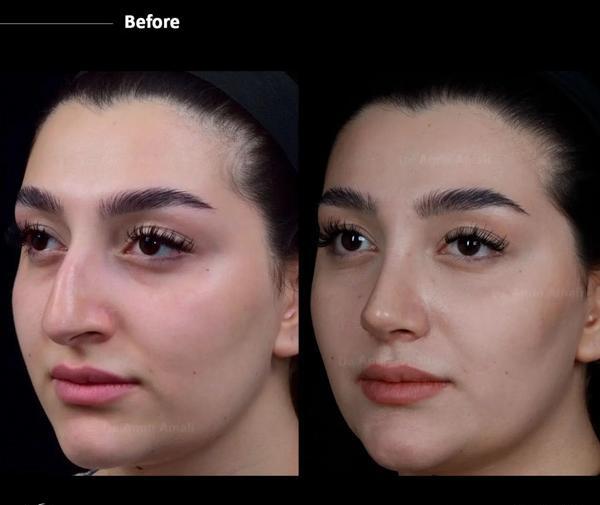 عکس قبل از عمل جراحی بینی