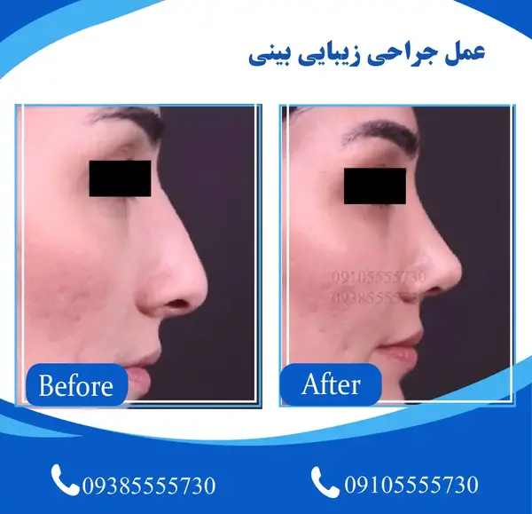عکس قبل از عمل جراحی بینی