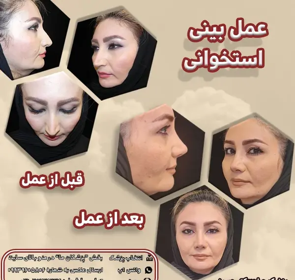عکس قبل از عمل جراحی بینی