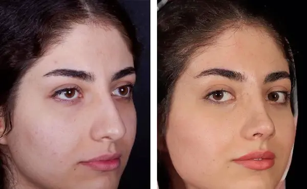 عکس قبل از عمل جراحی بینی