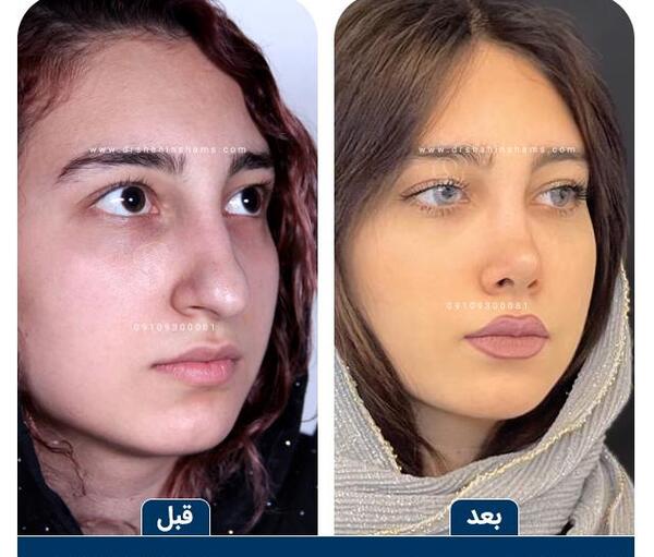 عکس قبل از عمل جراحی بینی
