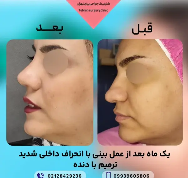 عکس قبل از عمل جراحی بینی