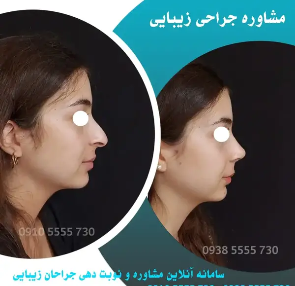 عکس قبل از عمل جراحی بینی