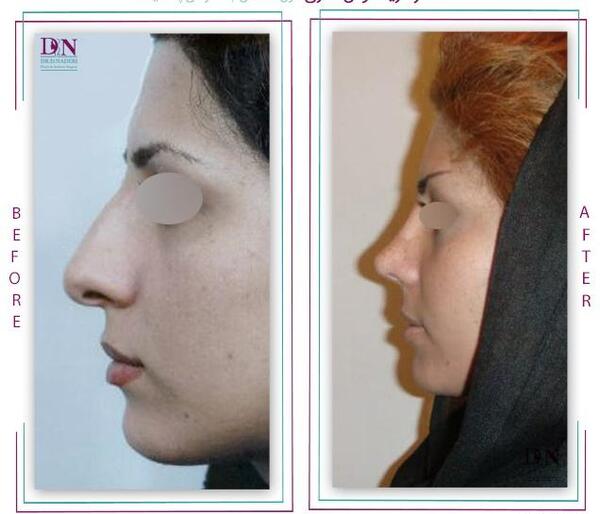عکس قبل از عمل جراحی بینی