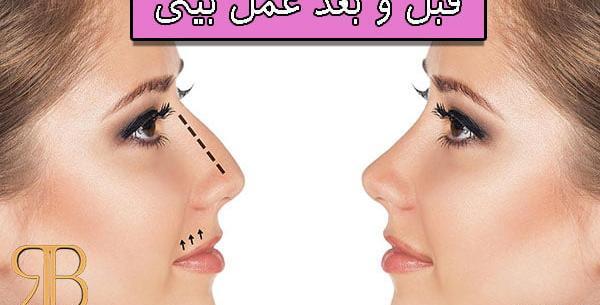 عکس قبل از عمل جراحی بینی