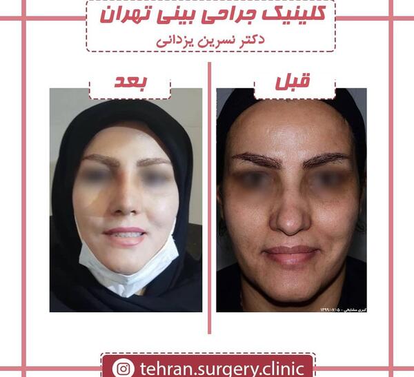 عکس قبل از عمل جراحی بینی