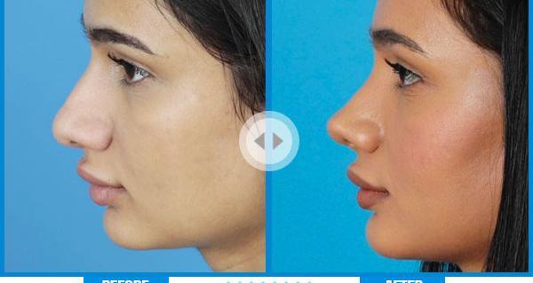عکس قبل و بعد جراحی بینی گوشتی