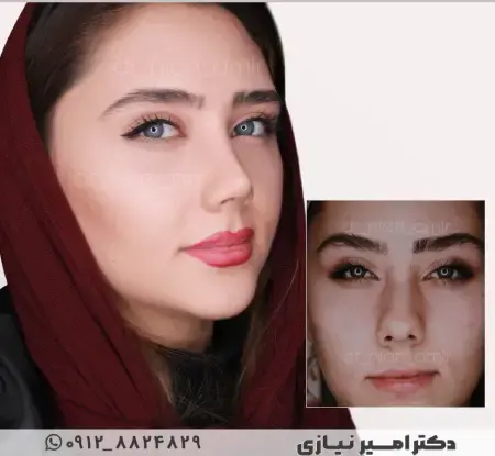 عکس قبل و بعد جراحی بینی گوشتی