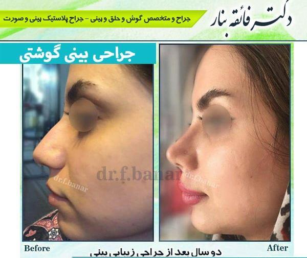 عکس قبل و بعد جراحی بینی گوشتی