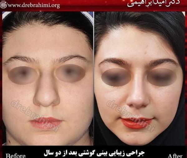 عکس قبل و بعد جراحی بینی گوشتی