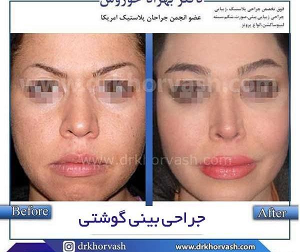 عکس قبل و بعد جراحی بینی گوشتی