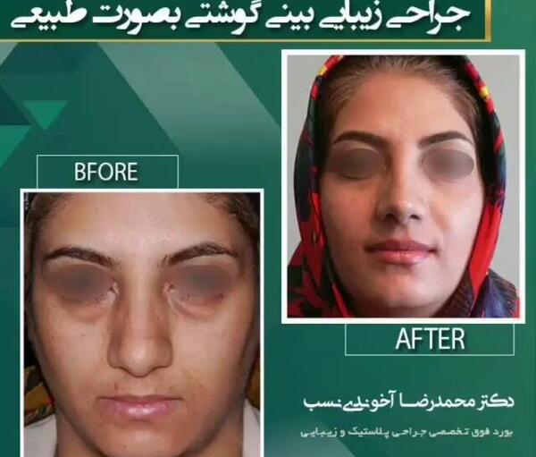 عکس قبل و بعد جراحی بینی گوشتی