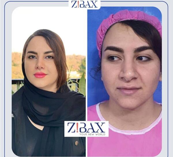 عکس قبل و بعد جراحی بینی گوشتی