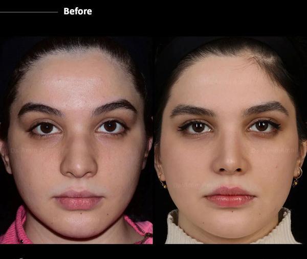 عکس قبل و بعد جراحی بینی گوشتی