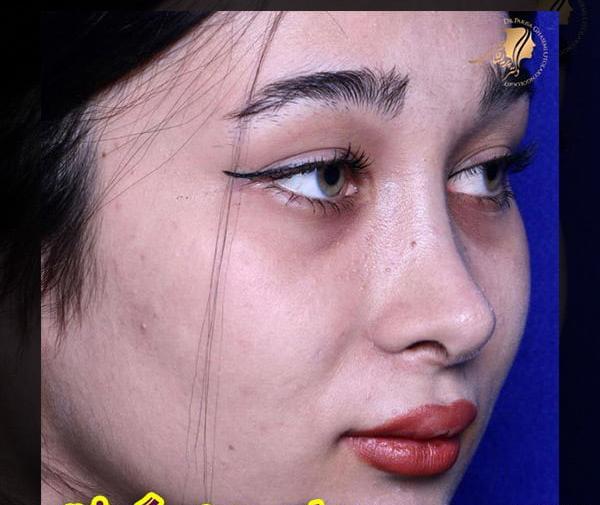 عکس قبل و بعد جراحی بینی گوشتی