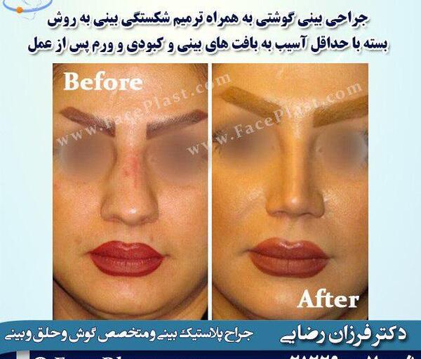 عکس قبل و بعد جراحی بینی گوشتی