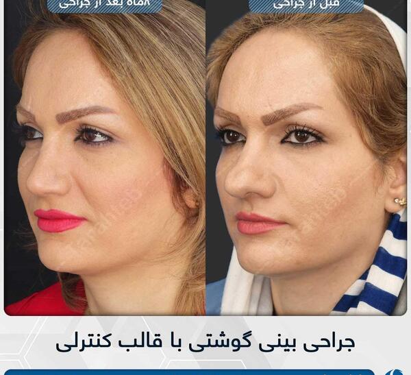 عکس قبل و بعد جراحی بینی گوشتی