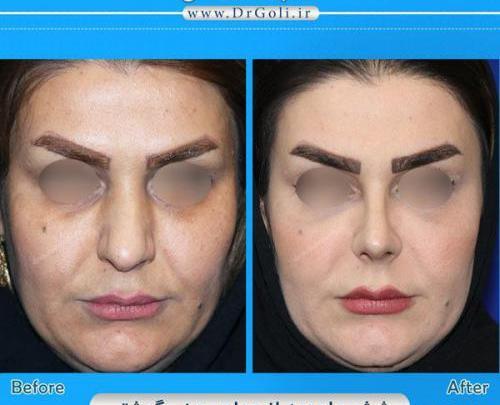 عکس قبل و بعد جراحی بینی گوشتی