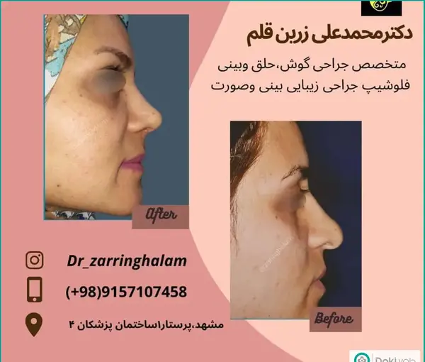 عکس قبل و بعد جراحی بینی گوشتی