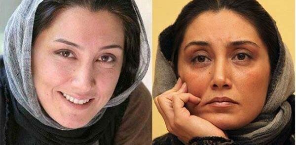 گرفتن عکس قبل از جراحی بینی