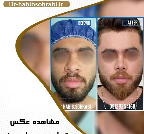 گرفتن عکس قبل از جراحی بینی