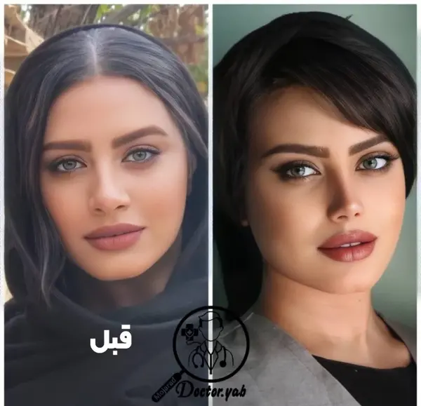 گرفتن عکس قبل از جراحی بینی