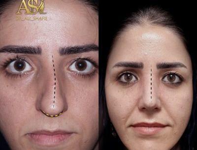 گرفتن عکس قبل از جراحی بینی