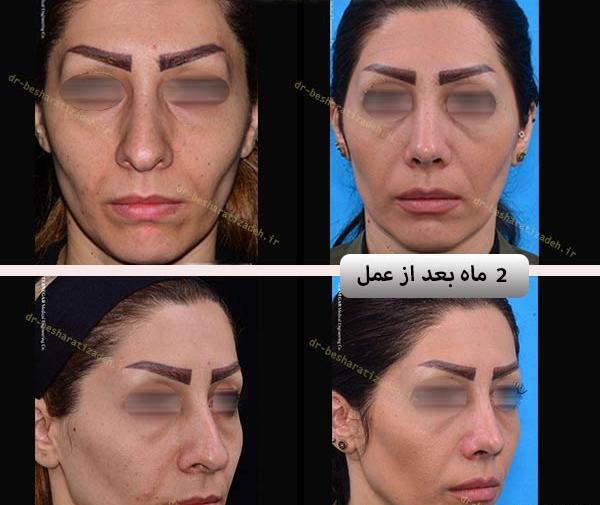 گرفتن عکس قبل از جراحی بینی