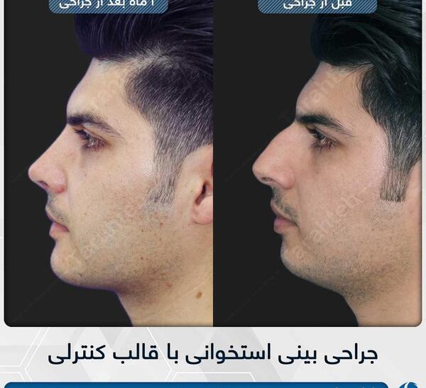 گرفتن عکس قبل از جراحی بینی