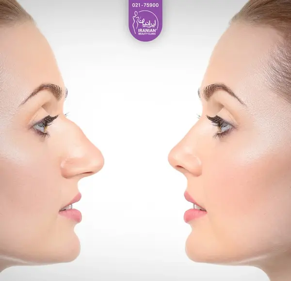 عکس جراحی بینی قبل و بعد عمل