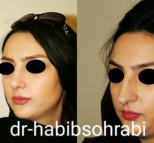 عکس جراحی بینی قبل و بعد عمل