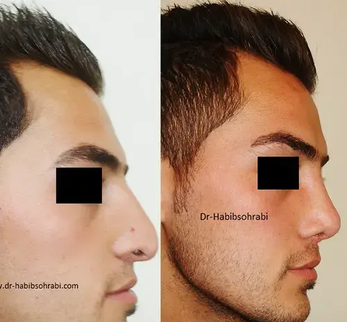 عکس جراحی بینی قبل و بعد عمل