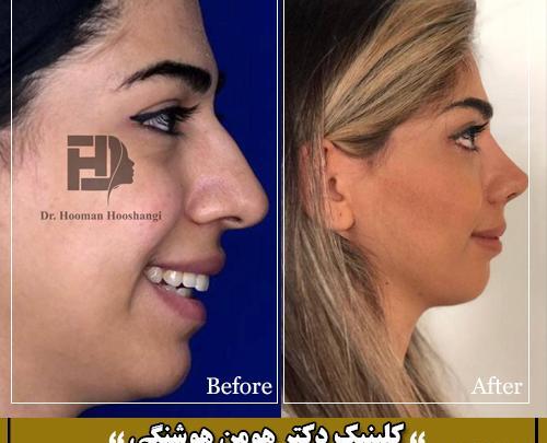 عکس جراحی بینی قبل و بعد عمل