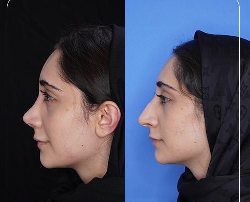 عکس جراحی بینی قبل و بعد عمل