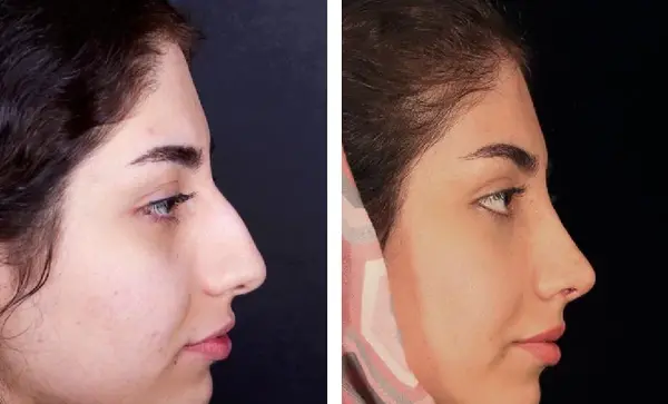 عکس قبل و بعد دماغ عملی
