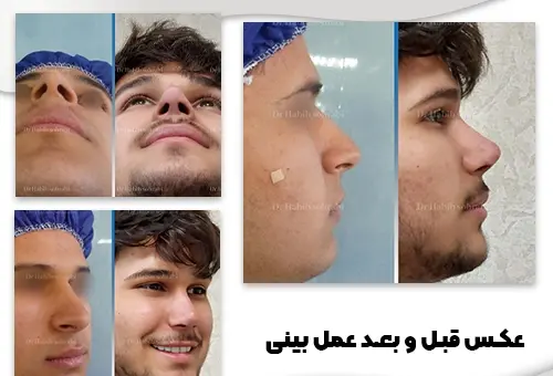 عکس قبل و بعد دماغ عملی