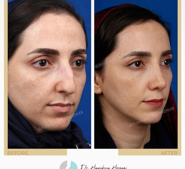 عکس قبل و بعد دماغ عملی