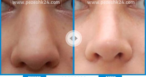 عکس قبل و بعد عمل دماغ گوشتی