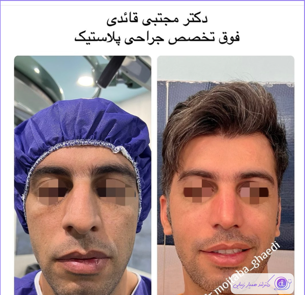عکس قبل و بعد عمل دماغ گوشتی