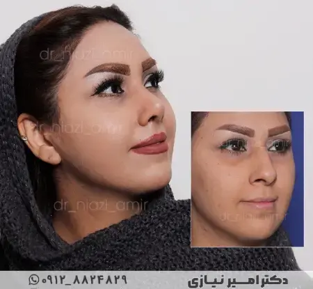 عکس قبل و بعد عمل دماغ گوشتی