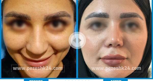عکس قبل و بعد عمل دماغ گوشتی