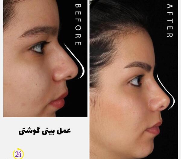 عکس قبل و بعد عمل دماغ گوشتی