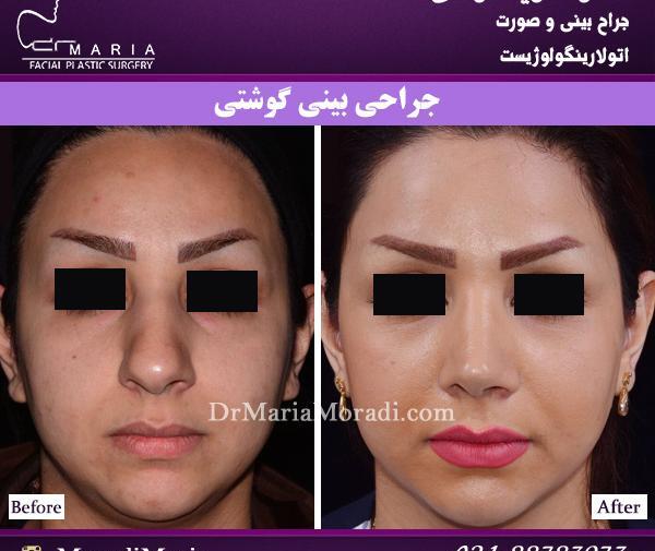 عکس قبل و بعد عمل دماغ گوشتی