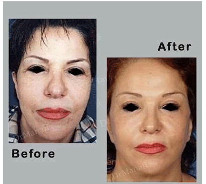 عکس قبل و بعد عمل دماغ گوشتی