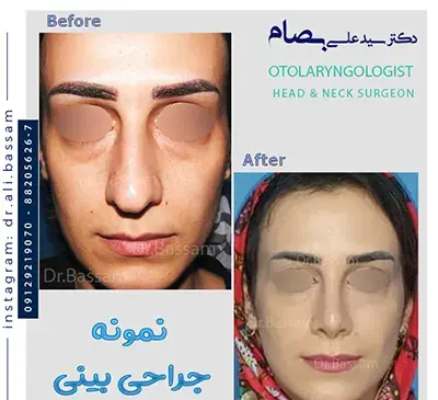 عکس قبل و بعد عمل دماغ گوشتی