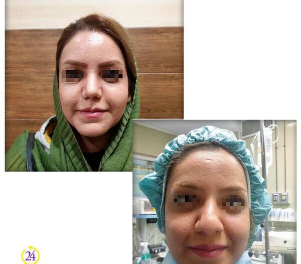 عکس دماغ عملی گوشتی قبل و بعد
