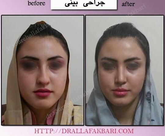 عکس دماغ عملی گوشتی قبل و بعد