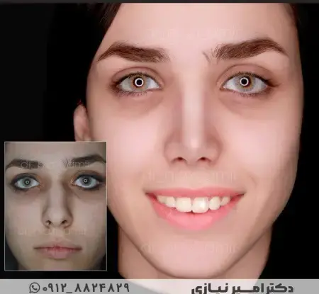 عکس دماغ عملی گوشتی قبل و بعد